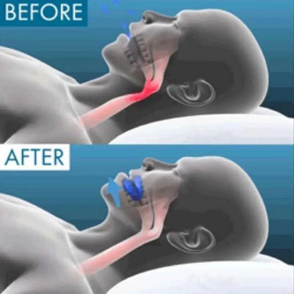 Reusable Snore Device Stopper anti Snoring Mouthpiece Reduce Snoring Aid Snore Solution for Comfort & Easy Breathing